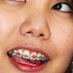 girl-with-braces-and-cell-phone
