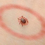 Curing Lyme disease - Causes and solutions | NaturalHealth365