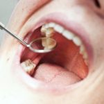 Poor oral health contributes to 6 common diseases