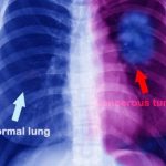 lung-cancer