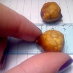 gallstones