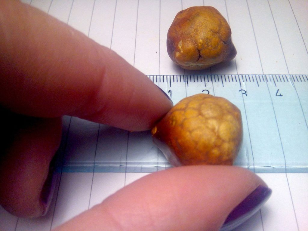 5 Ways to Eliminate Gallstones | NaturalHealth365