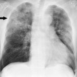 pneumonia