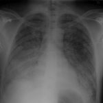 acute-respiratory-distress-syndrome