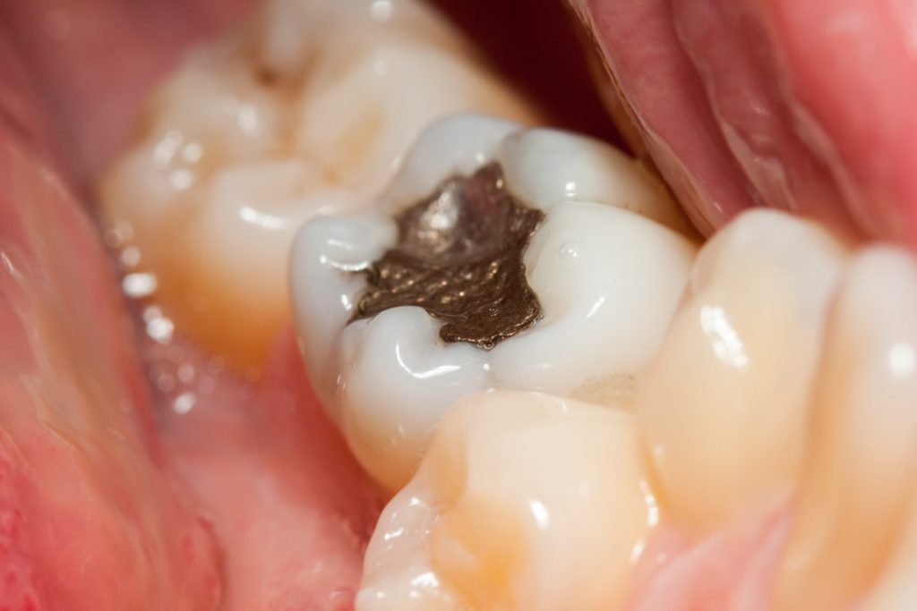 Amalgam Warning Issued by FDA Advisory Board | NaturalHealth365
