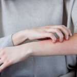 eczema-relief