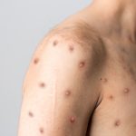 nih-funded-monkeypox-treatment