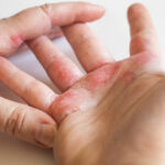eczema-symptoms
