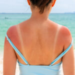 sunburn-eased-by-natural-substances