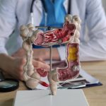 colon-cancer